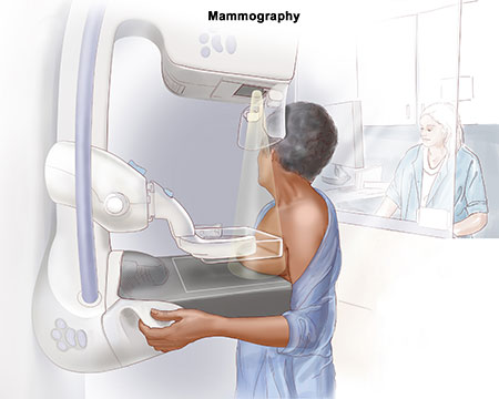 Chụp Xquang tuyến vú (Mamography)
