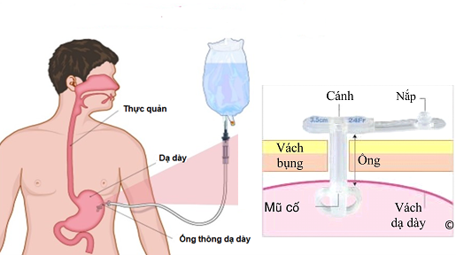 MỞ THÔNG DẠ DÀY RA DA QUA NỘI SOI