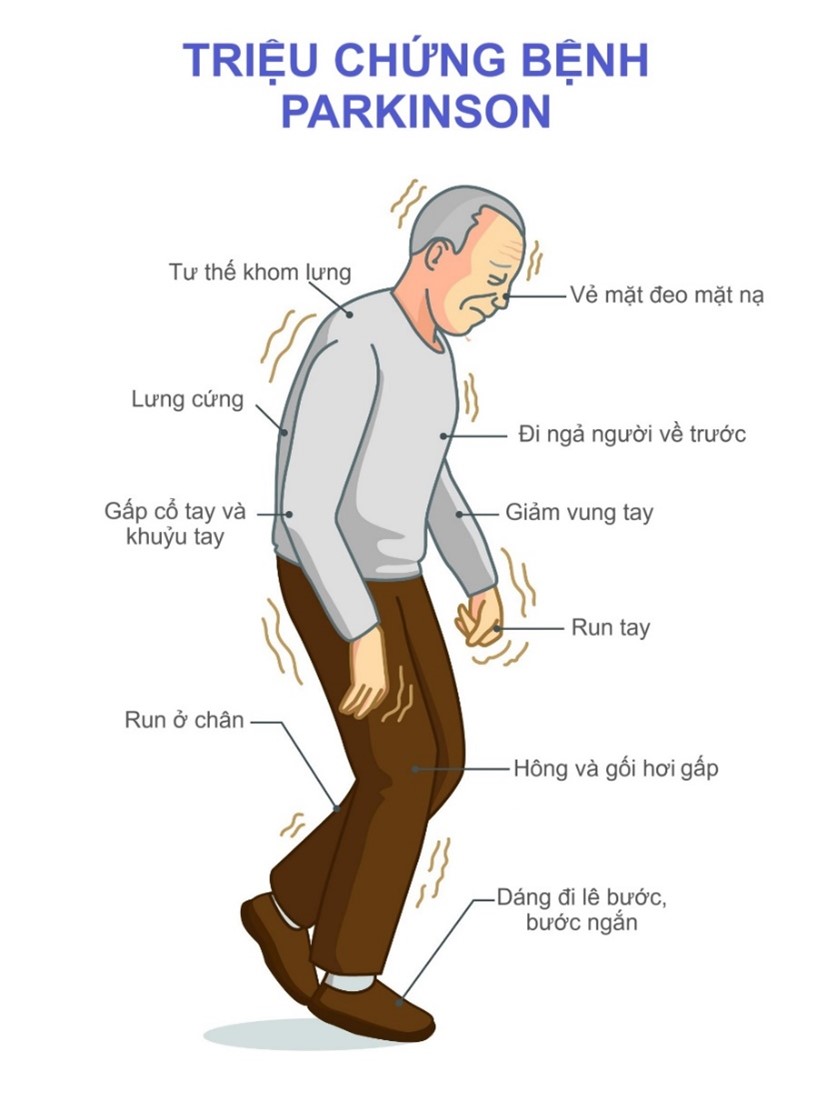 TRIỆU CHỨNG VẬN ĐỘNG Ở BỆNH NHÂN PARKINSON