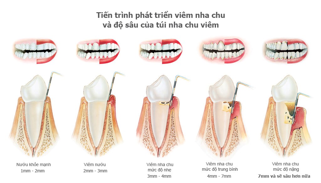 ĐÁI THÁO ĐƯỜNG VÀ SỨC KHỎE RĂNG MIỆNG